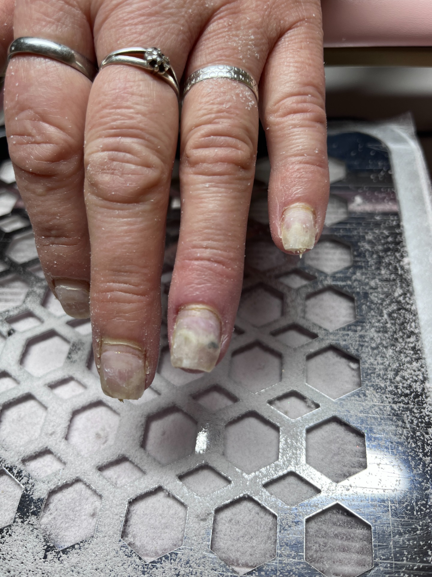 onycholýza a onychomykóza